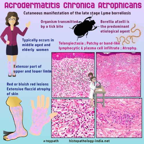 Pathology Of Acrodermatitis Chronica Atrophicans Dr Sampurna Roy Md