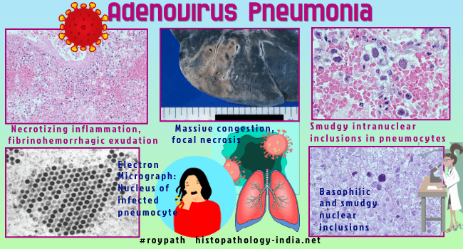 follicular conjunctivitis histology