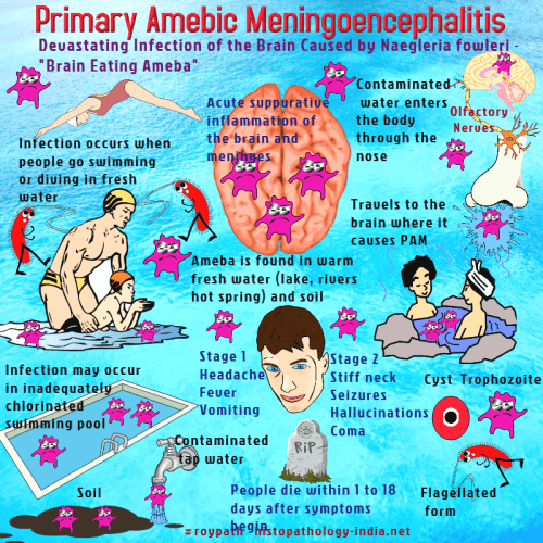 「Naegleria fowleri symptoms」の画像検索結果