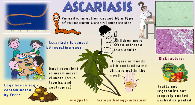 ascaris ascariasis