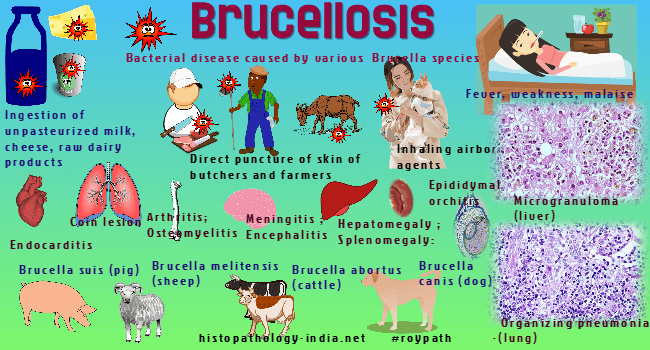 pathology of brucellosis - dr sampurna roy md