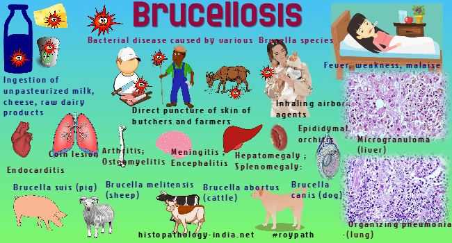 Pathology of Brucellosis - Dr Sampurna Roy MD