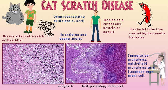 Pathology Of Cat Scratch Disease Dr Sampurna Roy Md