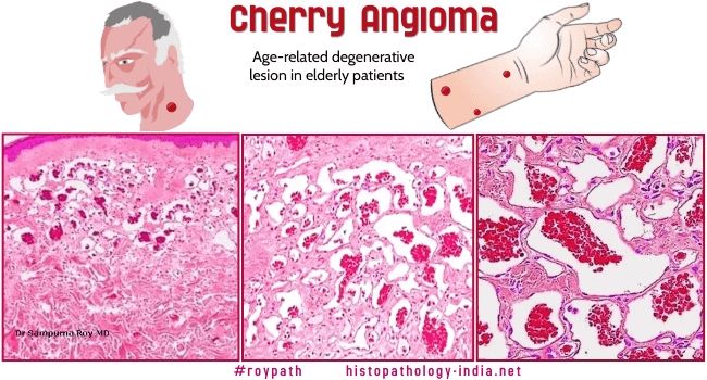 Pathology Of Cherry Angioma Senile Angioma Campbell De Morgan Spots 