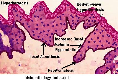 hyperkeratosis papillomatosis and acanthosis