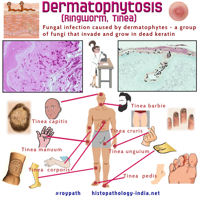 Pathology of Dermatophytosis - Dr Sampurna Roy MD