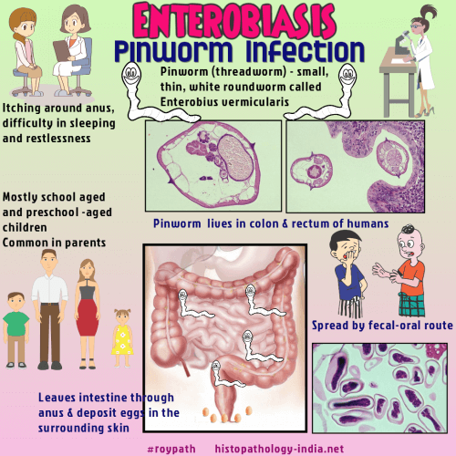 enterobiasis enterobius vermicularis