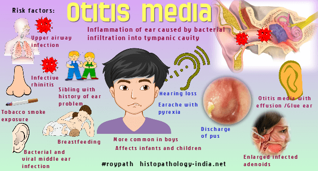 Librería Párrafo Implacable Pathology of Otitis Media - Dr Sampurna Roy MD