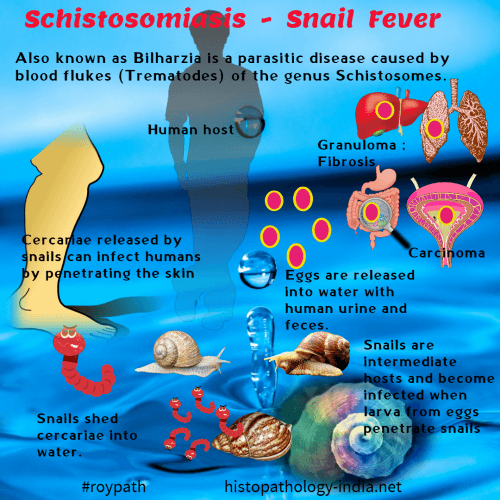 Schistosomiasis is caused by