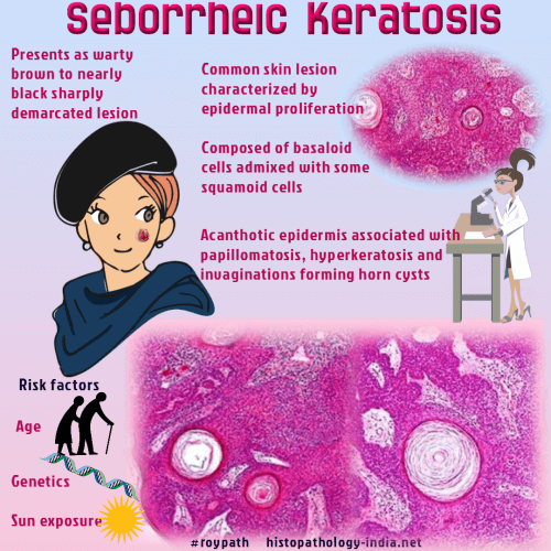 hyperkeratosis papillomatosis