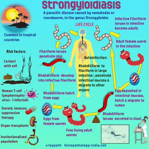 Strongyloida fertőzés (strongyloidosis) - Strongyloidosis stercoralis