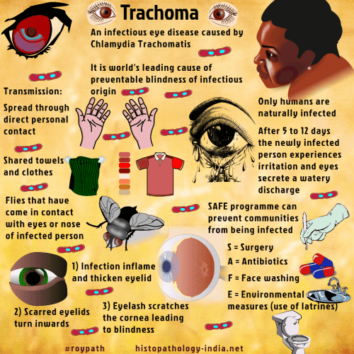 Trachoma Conjunctivitis Trachoma Conjunctivitis