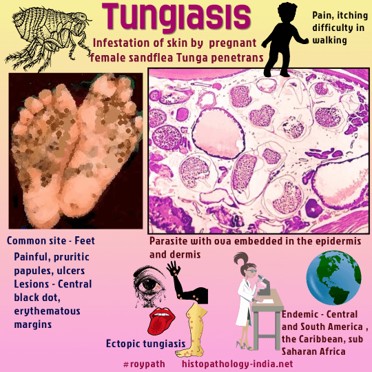 Pathology of Tungiasis - A Neglected Parasitic Disease - 10 important facts  - Dr Sampurna Roy MD