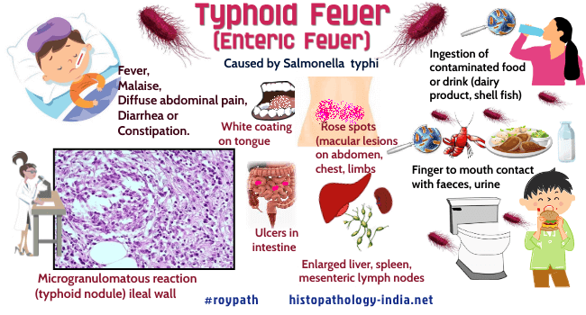Typhoid Fever 
